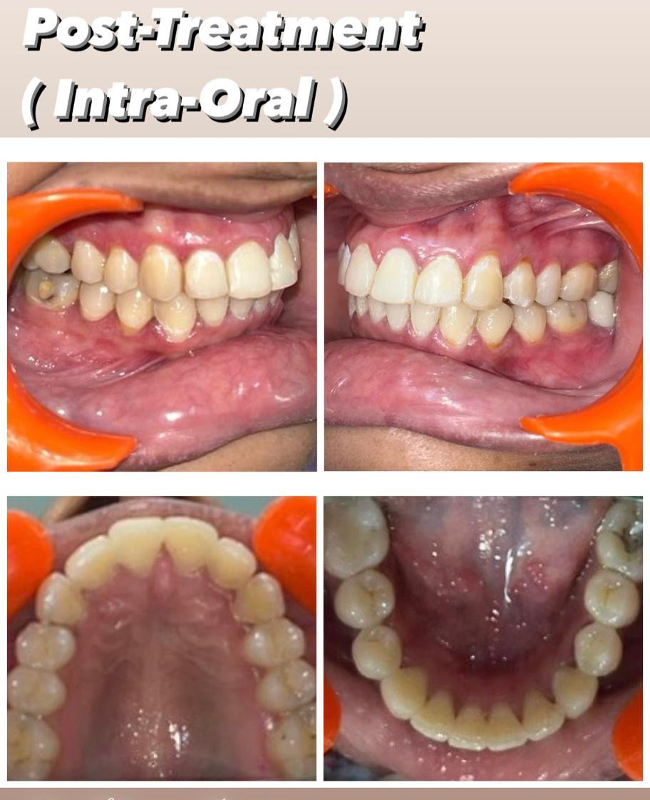 Case 3 post-treatment crowding intra-oral records
