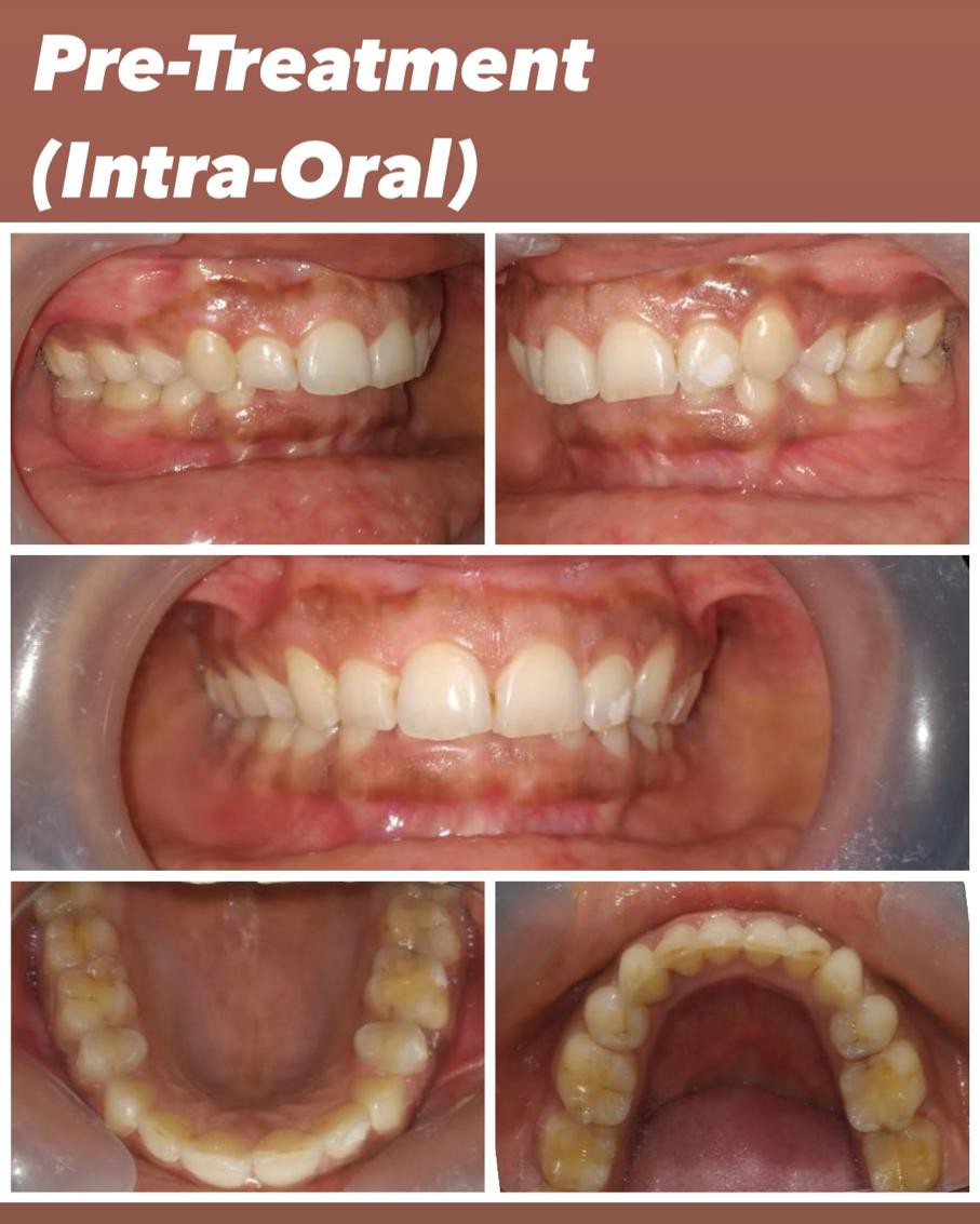 Case 4 pre-treatment deep bite intra-oral records
