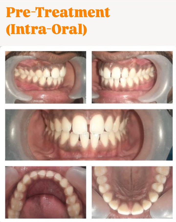 Case 2 pre-treatment spacing intra-oral records