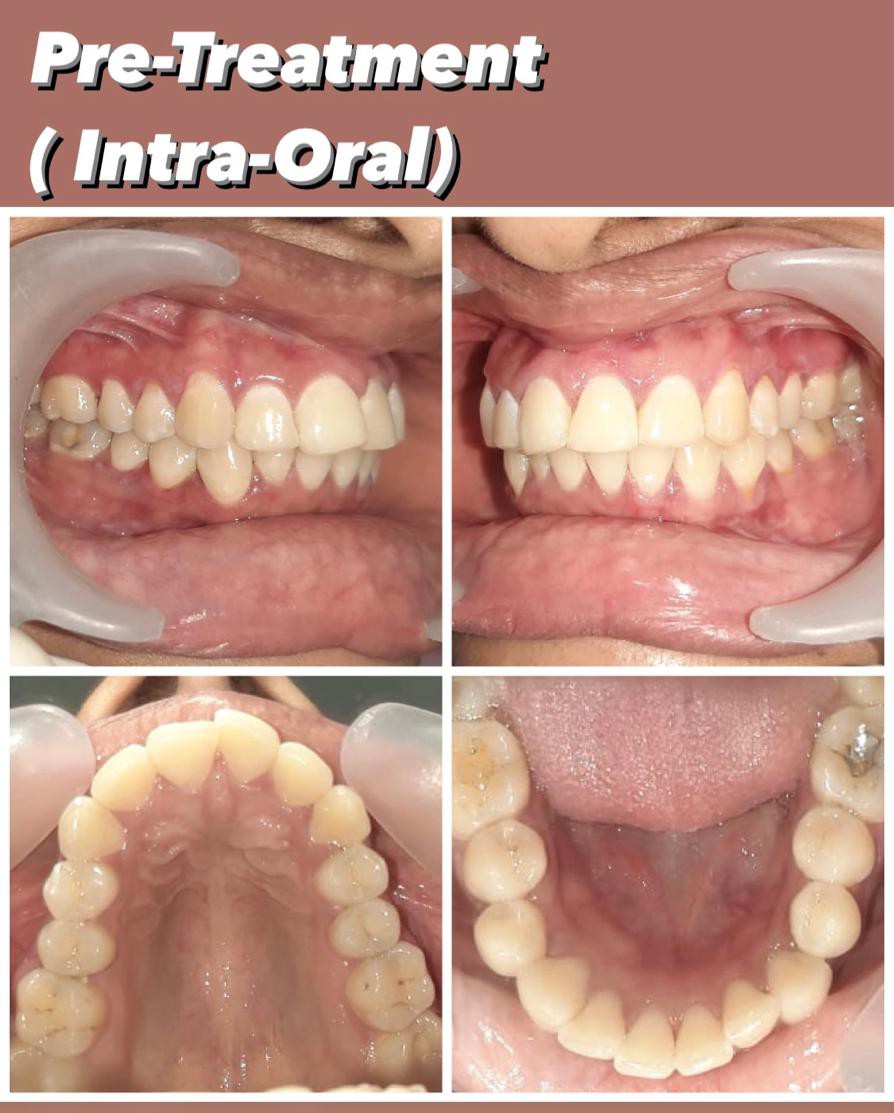 Case 3 pre-treatment crowding intra-oral records