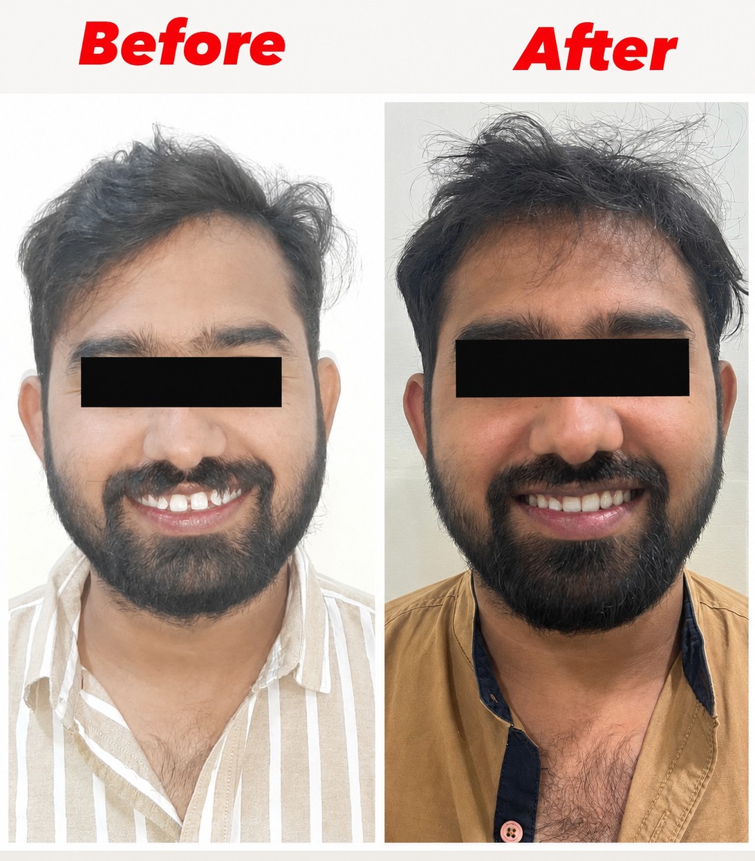Case 5 before and after facial view of severe spacing correction