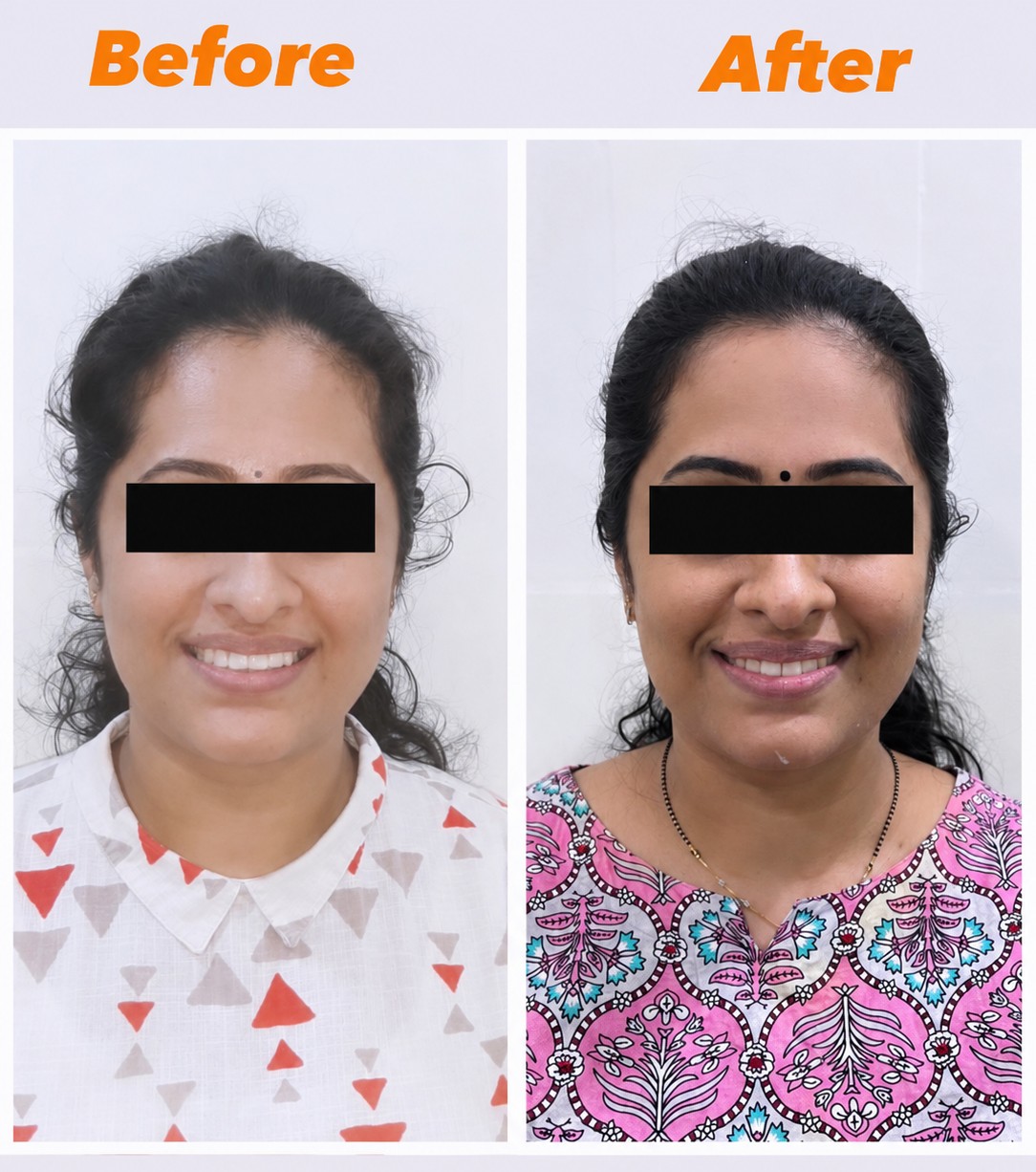 Case 3 before and after facial view of crowding correction