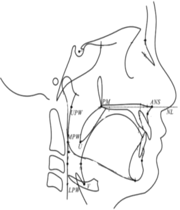 Airway analysis cephalometric tracing