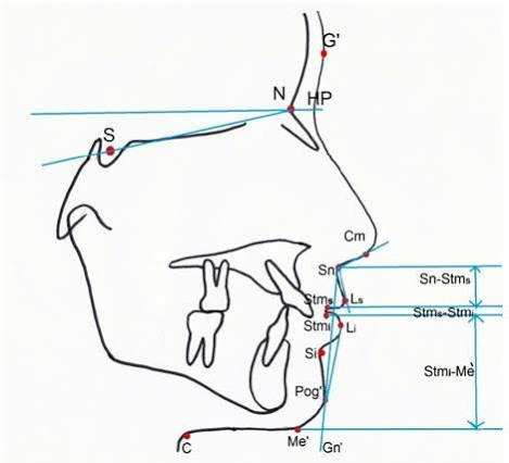 Soft tissue profile analysis