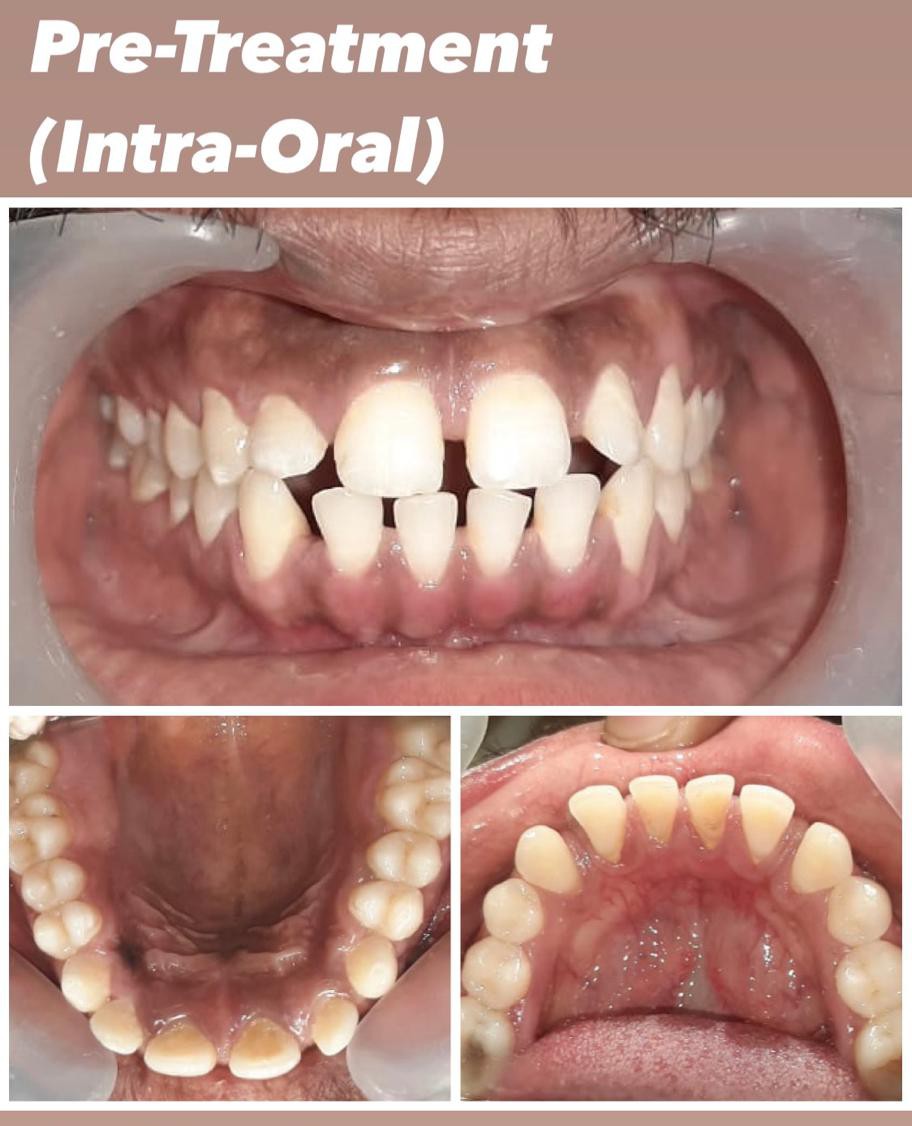 Case 5 pre-treatment severe spacing intra-oral records