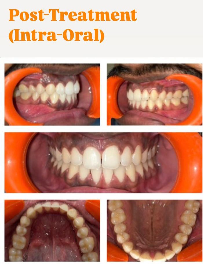 Case 2 post-treatment spacing intra-oral records
