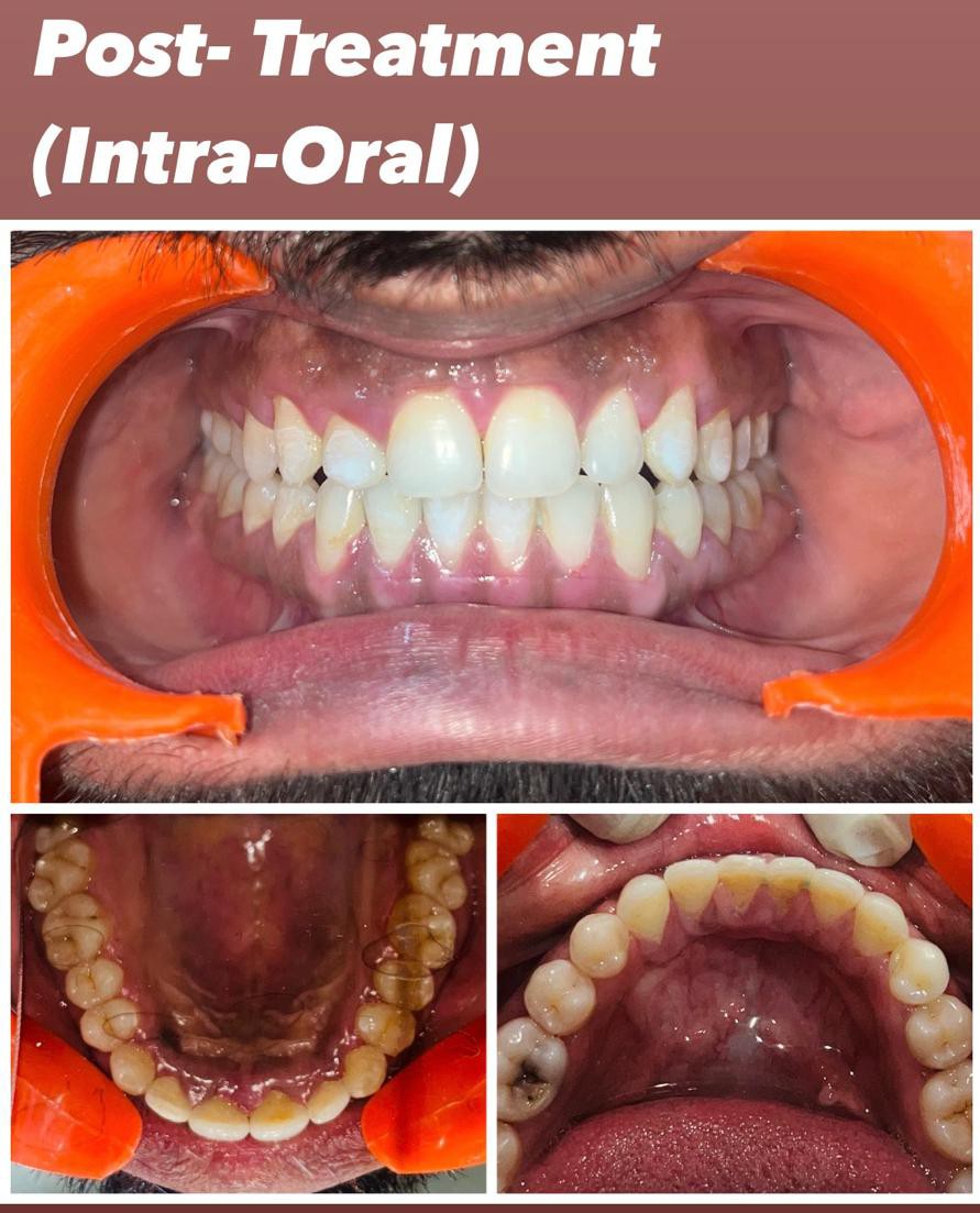 Case 5 post-treatment severe spacing correction intra-oral records