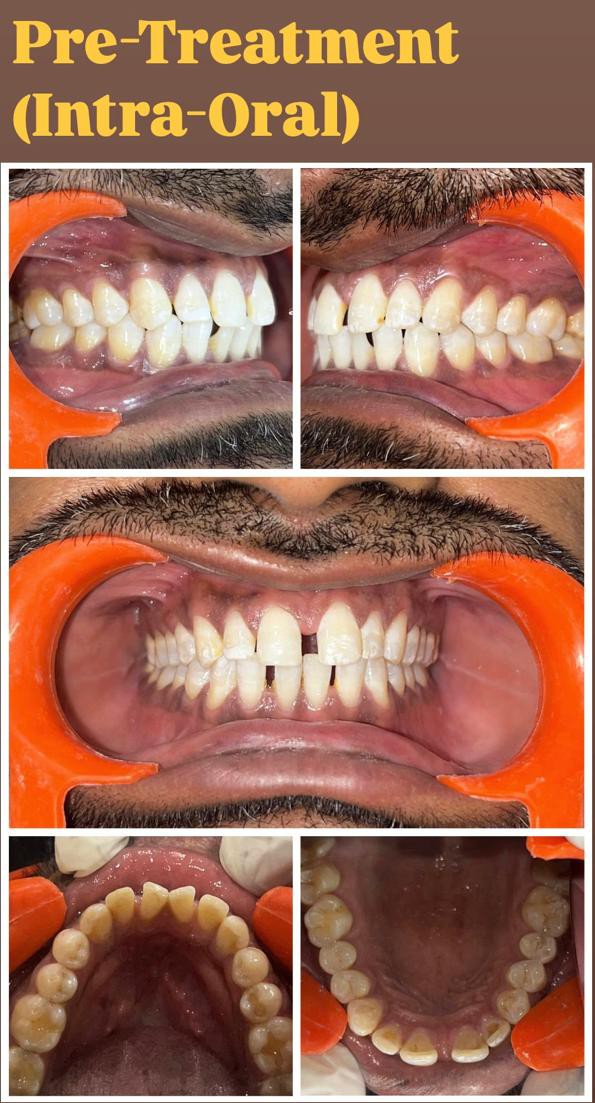 Case 1 pre-treatment midline diastema intra-oral records