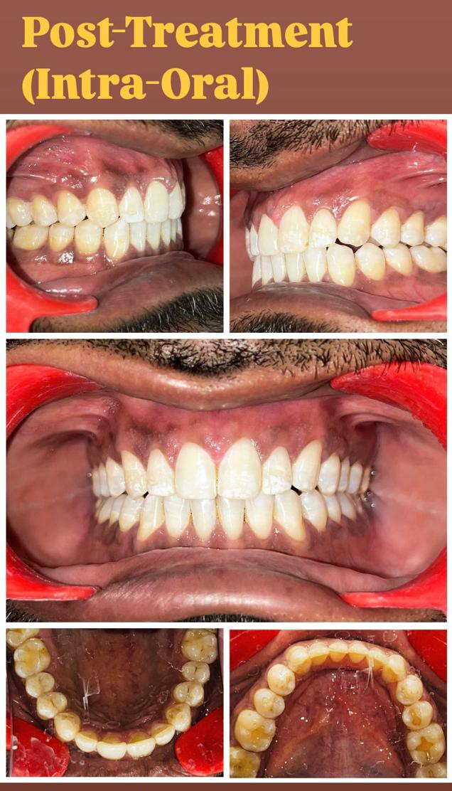 Case 1 post-treatment midline diastema intra-oral records