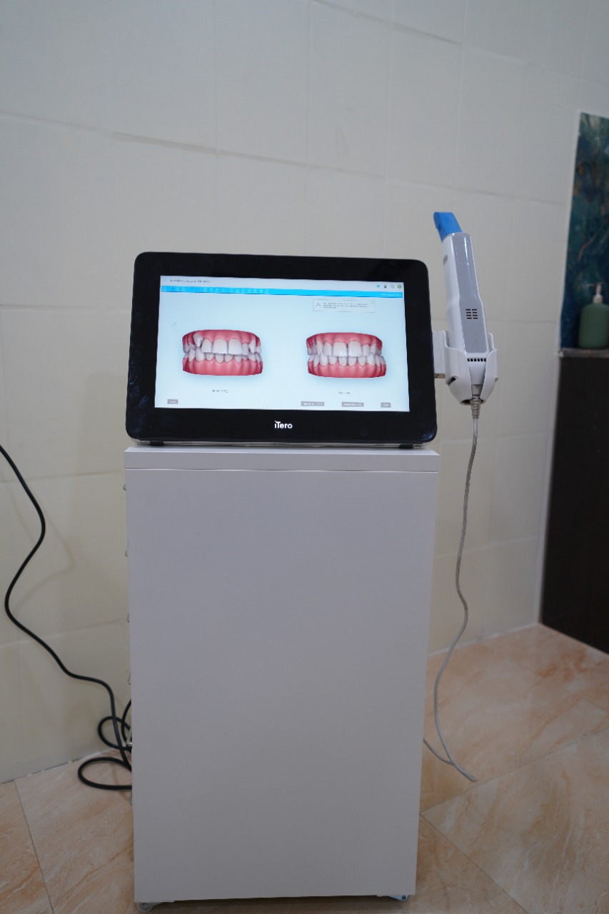 iTero digital scanner