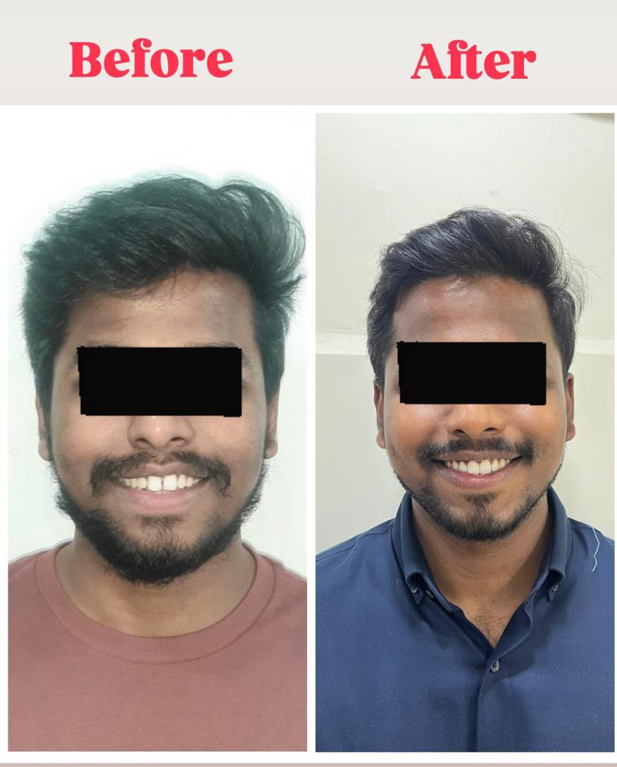 Case 2 before and after facial view of spacing correction