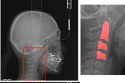 Lateral cephalogram with cervical spine highlighted for postural and soft tissue assessment