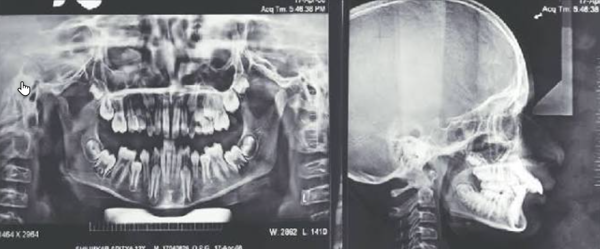 Lateral cephalogram and OPG radiographs