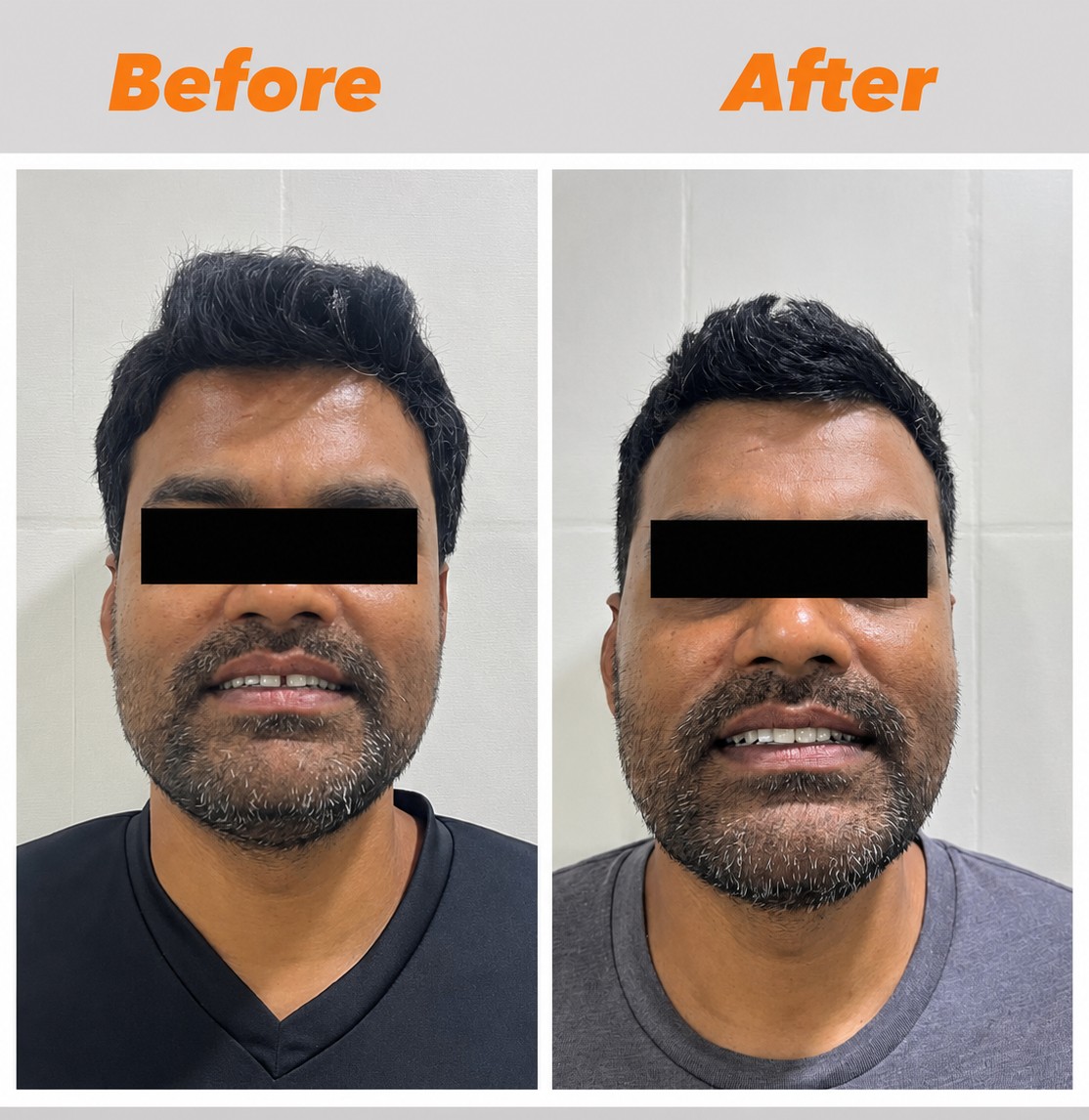 Case 1 before and after facial view of midline diastema correction