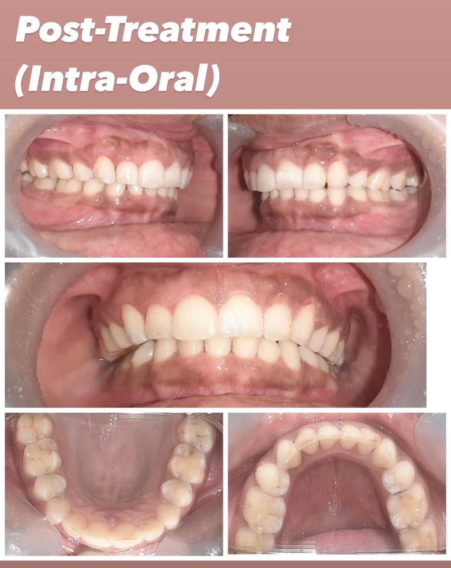 Case 4 post-treatment deep bite correction intra-oral records